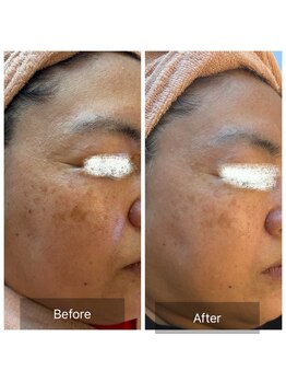 エメ(Aimer)/【50代日光性シミ結果写真☆】