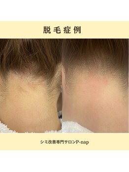 ピーナップ(P-nap)/襟足脱毛