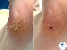 プラスワンフット 本厚木(+1 Foot)/タコ・魚の目ケア！痛みから解放