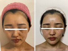 ダルセーニョ/小顔コルギ☆パーツ☆