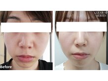 サロン カーサ(Salon Casa)/光フェイシャル施術前後