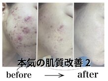 アルゴ 八幡黒崎店(ALGO)/本気の肌質改善2