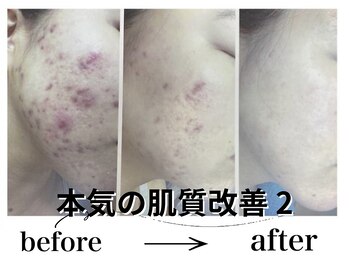 アルゴ 八幡黒崎店(ALGO)/本気の肌質改善2