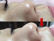 ブリリアン デイスパ 阪急西宮ガーデンズ店(BRILLIAN DAYSPA)/毛穴洗浄フェイシャル