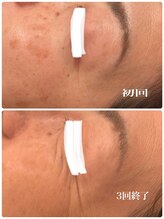 ディス イズ ミー エステティック(This is Me Aesthetic)/シミケアモニタープラン