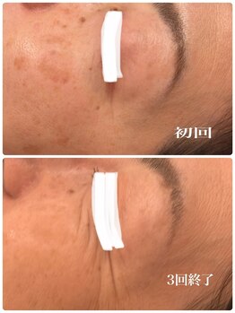 ディス イズ ミー エステティック(This is Me Aesthetic)/シミケアモニタープラン