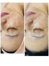 ナチュラルビューティラテ(NATURAL BEAUTY LATTE)/レチノールモニター