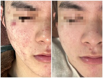 アンドナイン エス店(ANDNINE.)/20代ハーブピーリング