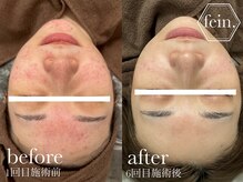 フェイン 青山店(fein.)の雰囲気（マンツーマンでの肌質改善♪しっかりと根本から改善を実感！）