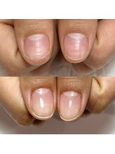 セラキュアネイル(Theracure nail)/美しい爪に成長させます