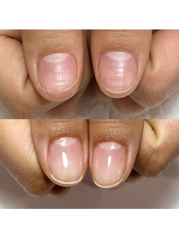 セラキュアネイル(Theracure nail)/美しい爪に成長させます