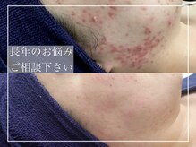 美肌専門サロン ベリッシア(BELLISIA)の雰囲気（長年のお悩みや将来の予防ケアなどご相談下さい(^^)）