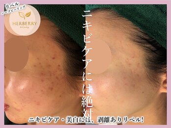 ハーバリー ハーブピーリング 難波心斎橋店(HERBERRYハーブピーリング)/なんばハーブピーリングHERBERRY