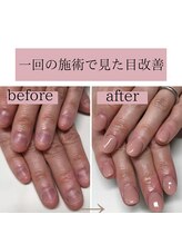 ティアラネイル(tiaranail)/再発させない深爪矯正