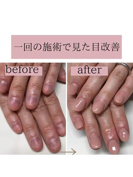 ティアラネイル(tiaranail)/再発させない深爪矯正