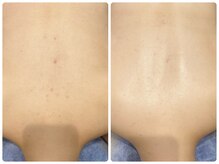 ブリリアント(Brilliant)/花嫁さん背中ニキビケア