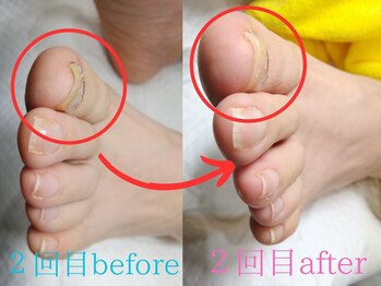 【巻き爪ケア】ネイル/フット