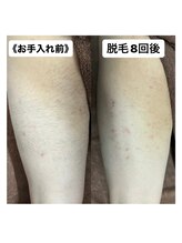 ミノア 大野城店(MINOA)/全身脱毛　9回ビフォ‐アフタ‐