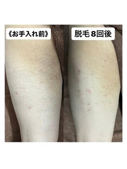 ミノア 大野城店(MINOA)/全身脱毛 9回ビフォ‐アフタ‐