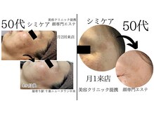 50代/60代からシミケアを始める方が増えています