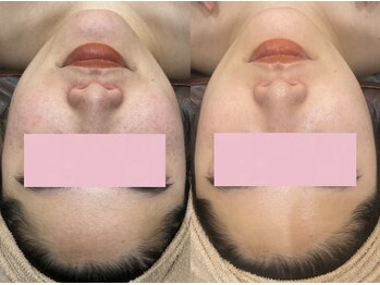 レイビス 仙台店(RAYVIS)/毛穴レス肌♪