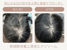 ストーリー 小田原(STORY)/幹細胞培養上清液☆エクソソーム