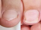 都内へ行かずに叶う足の深爪矯正