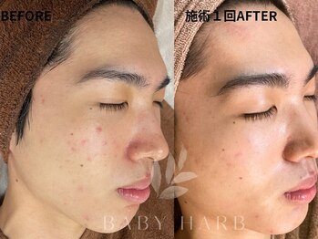 フィズ 戸塚店(FIS)/☆ハーブピーリング☆都度払い