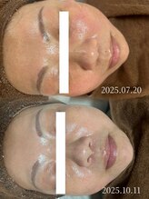 ビーグロウ(be Grow)/before/after