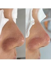 ニュートラル(neutral)/毛穴エクストラクションプロ大分