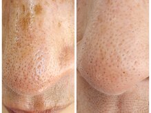 シュエット(chouette)の雰囲気（【before→after】毛穴ケア《痛みゼロ！エクストラクション》）