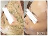 【肌質根本改善】剥離なし★REVIハーブピーリング ¥15,400→