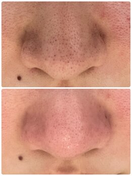 エースマイルイズ(A smile is..)/毛穴洗浄美肌コース