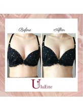 ウルエッテ(UluEtte)/ブラジャーがパンパン/福岡豊胸
