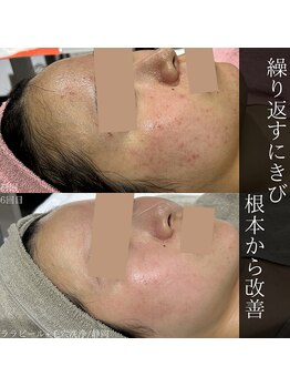 アウラプラス(Aura+)/にきびケア/改善症例