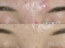 コウル 川西能勢口店(geoul)/透明感アップコース3回