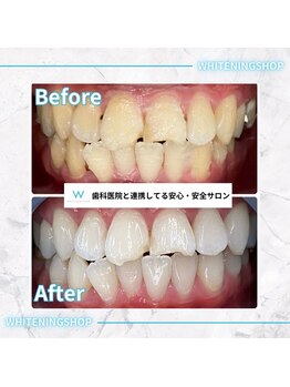 ホワイトニングショップ 甲府店/ホワイトニングの効果