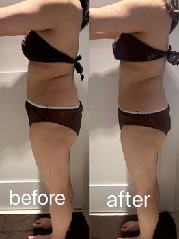 マドモアゼル 麻布十番/痩身インディバ