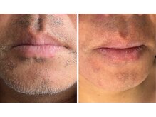 フーレスト アンド フリーリー(Fullest&Freely)/男性人気！ヒゲ脱毛