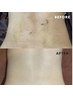 【即効性を求める方】レディース全身美肌脱毛（顔＆VIO込）￥15000
