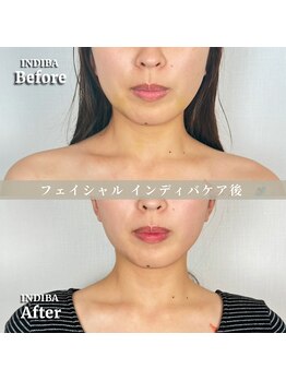 術後の女神 大阪心斎橋店/術後ケアインディバ・インディバ