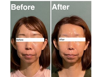 ミエーレ(miele)/Before & After 　40代女性