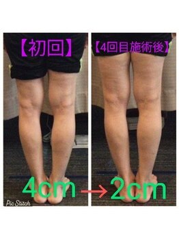 クシロ鍼灸整骨院/【O脚矯正】施術例