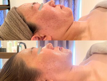 ニコテ(Nicote)/肌育ボンバーフェイシャル