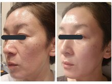 ノア(NOA.)/【あらゆるお肌悩みに光フォト】