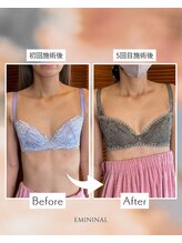 エミニナル(EMININAL)/【バストケア】ビフォーアフター