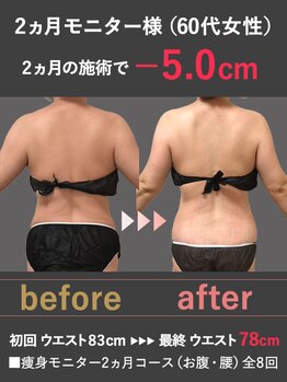 蓮子の夢の写真/最新機器で背中・二の腕をスリムに！二の腕や背中のはみ肉スッキリを目指す！