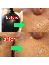 スマイルミー/フェイシャルBBL