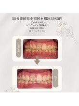 プラスビーセルフ(+b self)/ホワイトニングビフォーアフター