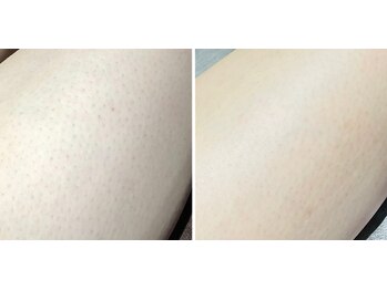 エスケア(S-CARE)/脱毛でお肌が輝く☆